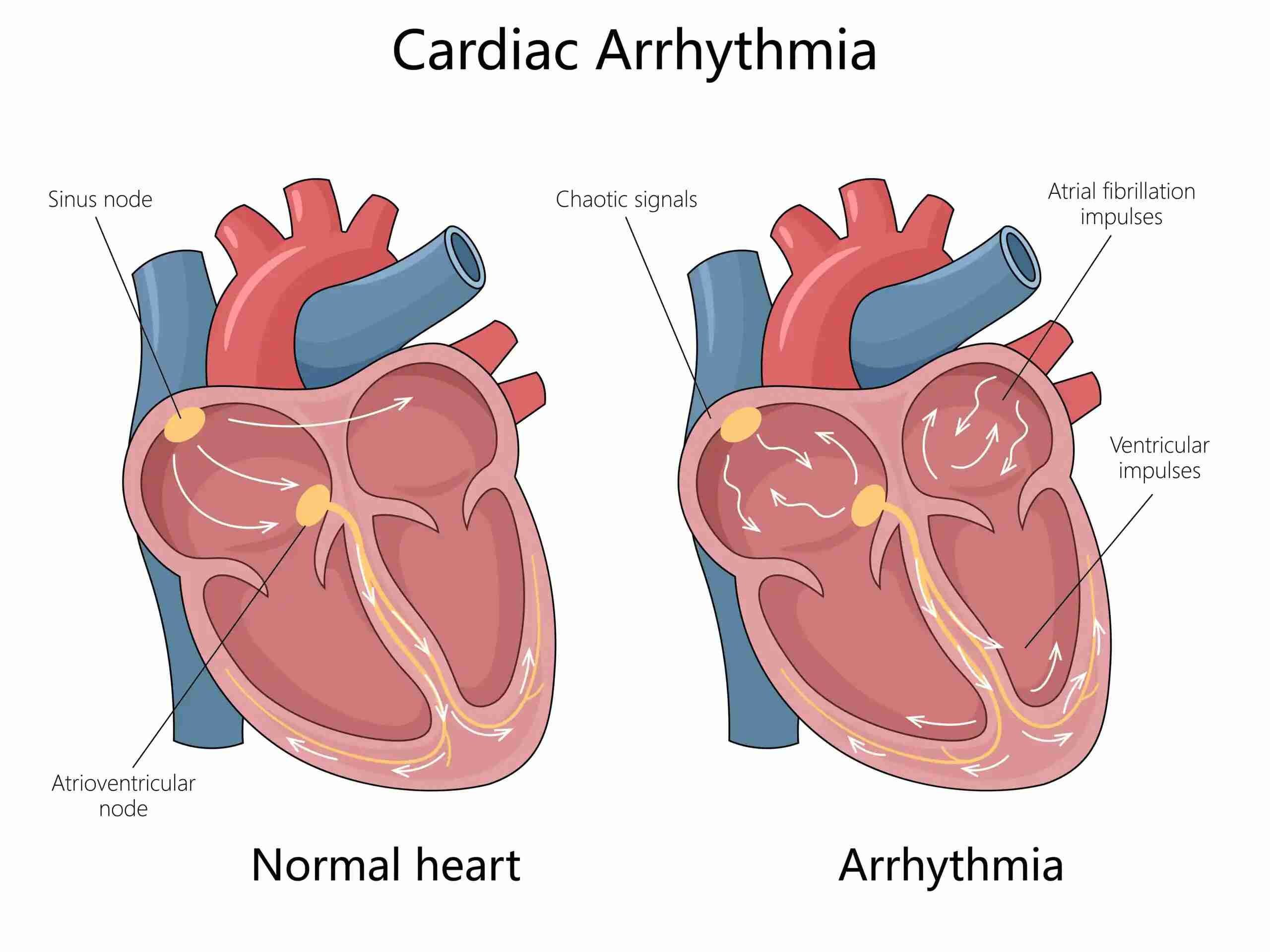 aritmia